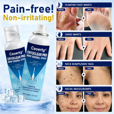 Ceoerty® bump renewal spray with dimethyl ether cooling technology